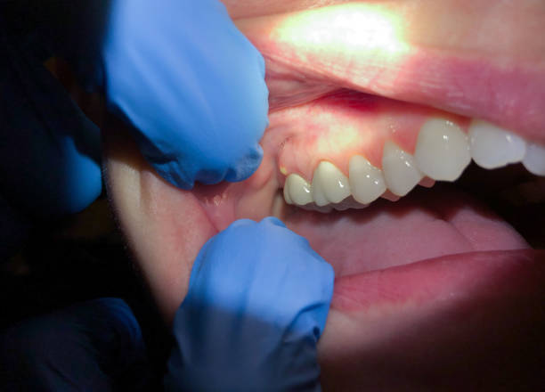 Best Emergency Tooth Extraction in Gilbertsville, PA